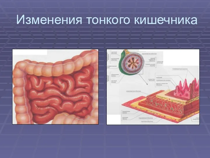 Изменения тонкого кишечника