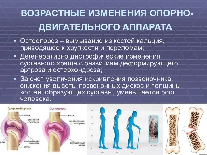 ВОЗРАСТНЫЕ ИЗМЕНЕНИЯ ОПОРНО-ДВИГАТЕЛЬНОГО АППАРАТА Остеопороз – вымывание из костей кальция, приводящее к