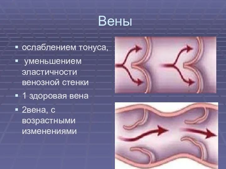 Вены ослаблением тонуса, уменьшением эластичности венозной стенки 1 здоровая вена 2вена, с возрастными изменениями