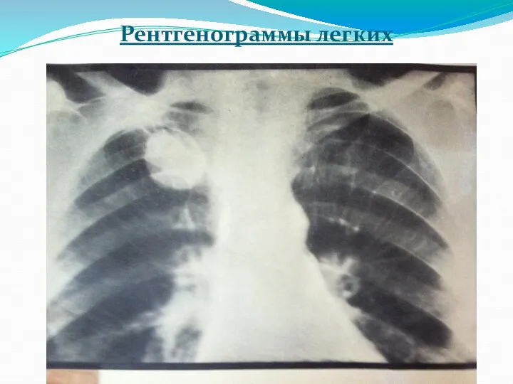 Рентгенограммы легких