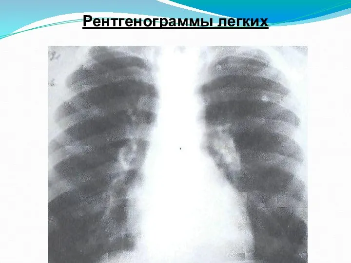 Рентгенограммы легких