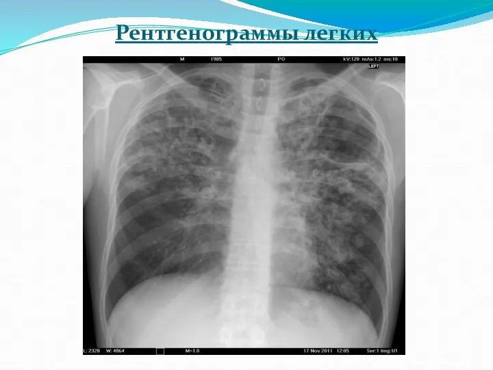 Рентгенограммы легких