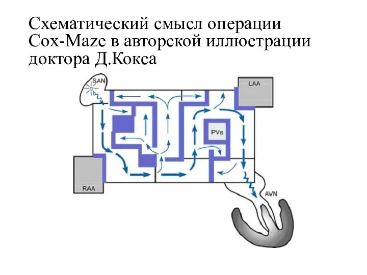 Схематический смысл операции Cox-Maze в авторской иллюстрации доктора Д.Кокса