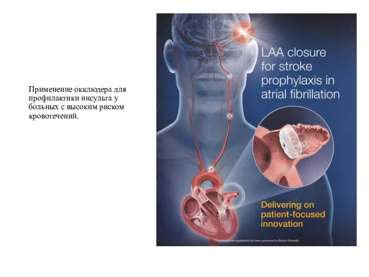 Применение окклюдера для профилактики инсульта у больных с высоким риском кровотечений.