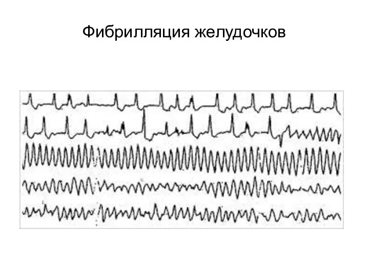 Фибрилляция желудочков