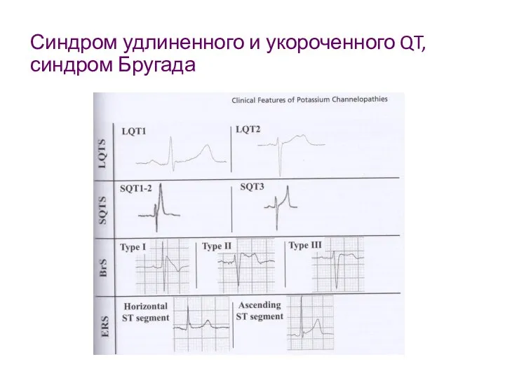 Синдром удлиненного и укороченного QT, синдром Бругада