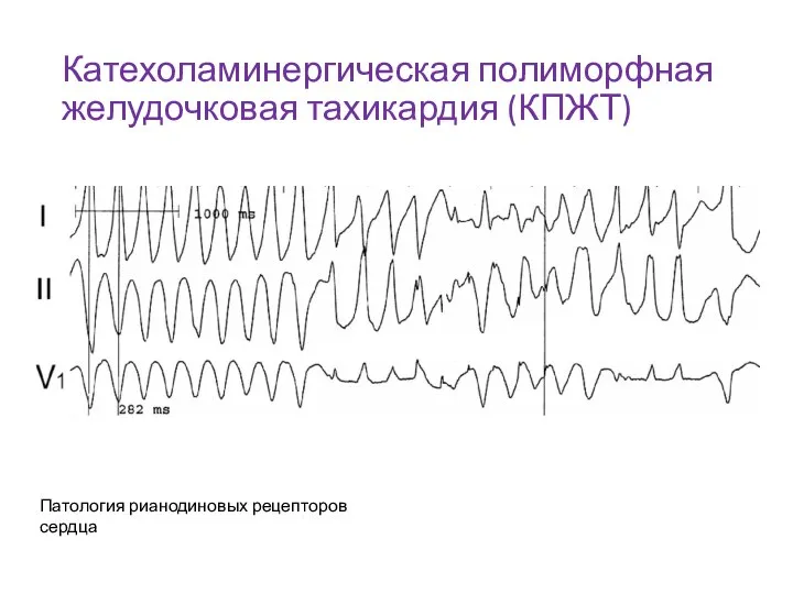 Катехоламинергическая полиморфная желудочковая тахикардия (КПЖТ) Патология рианодиновых рецепторов сердца