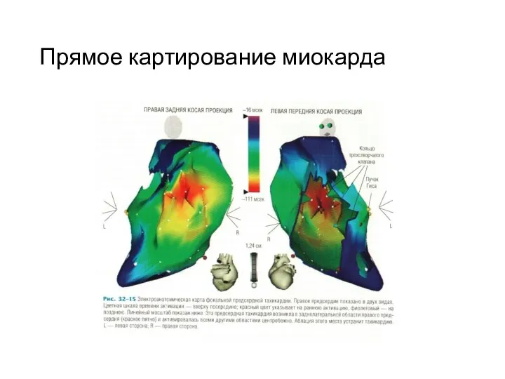 Прямое картирование миокарда