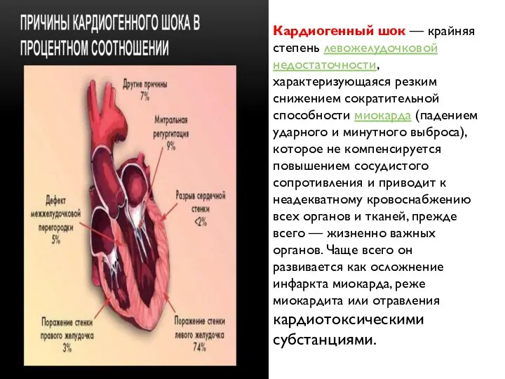 Кардиогенный шок — крайняя степень левожелудочковой недостаточности, характеризующаяся резким снижением сократительной способности