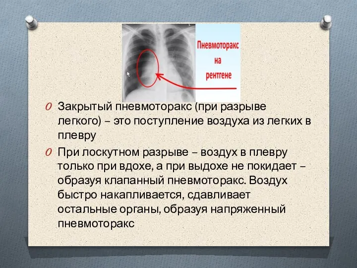 Закрытый пневмоторакс (при разрыве легкого) – это поступление воздуха из легких в