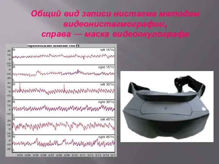 Общий вид записи нистагма методом видеонистагмографии, справа — маска видеоокулографа