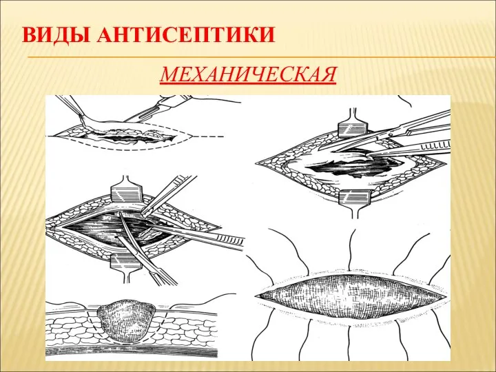 ВИДЫ АНТИСЕПТИКИ МЕХАНИЧЕСКАЯ