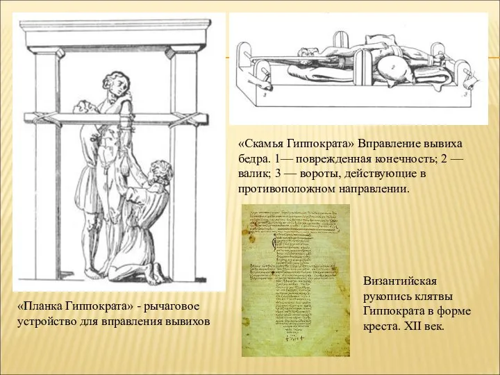 «Планка Гиппократа» - рычаговое устройство для вправления вывихов «Скамья Гиппократа» Вправление вывиха