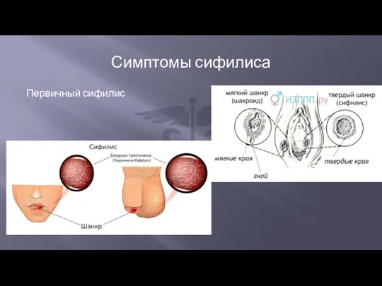 Первичный сифилис Симптомы сифилиса