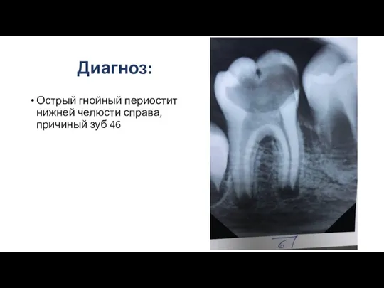 Диагноз: Острый гнойный периостит нижней челюсти справа, причиный зуб 46