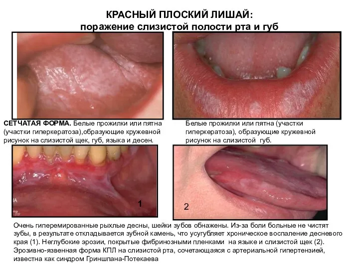 КРАСНЫЙ ПЛОСКИЙ ЛИШАЙ: поражение слизистой полости рта и губ СЕТЧАТАЯ ФОРМА. Белые