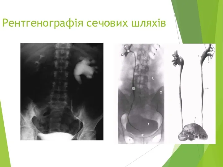 Рентгенографія сечових шляхів