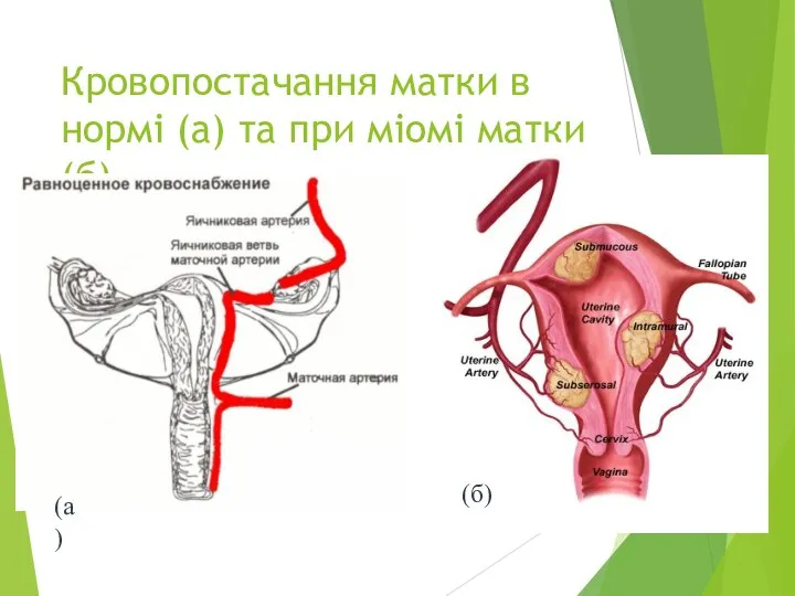 Кровопостачання матки в нормі (а) та при міомі матки (б) (а) (б)