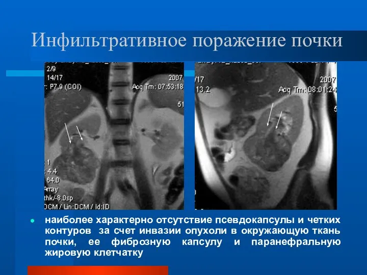 Инфильтративное поражение почки наиболее характерно отсутствие псевдокапсулы и четких контуров за счет