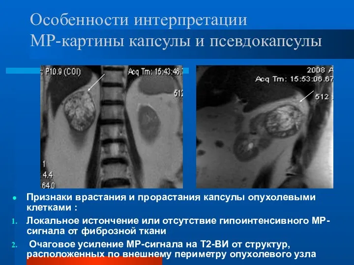 Особенности интерпретации МР-картины капсулы и псевдокапсулы Признаки врастания и прорастания капсулы опухолевыми