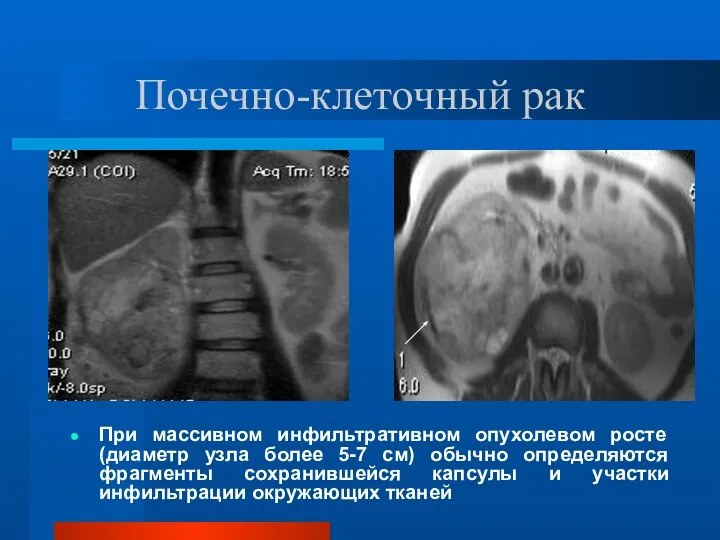 Почечно-клеточный рак При массивном инфильтративном опухолевом росте (диаметр узла более 5-7 см)