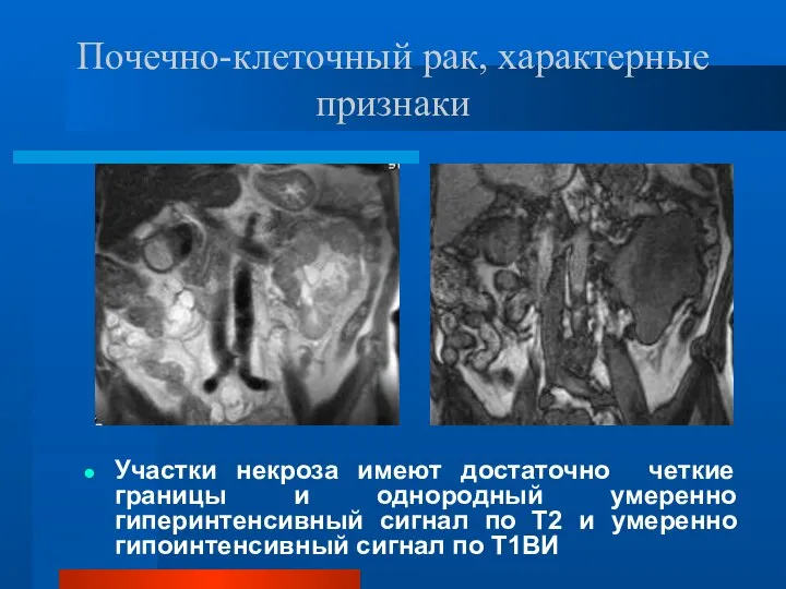 Почечно-клеточный рак, характерные признаки Участки некроза имеют достаточно четкие границы и однородный