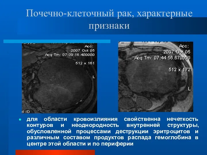 Почечно-клеточный рак, характерные признаки для области кровоизлияния свойственна нечеткость контуров и неоднородность