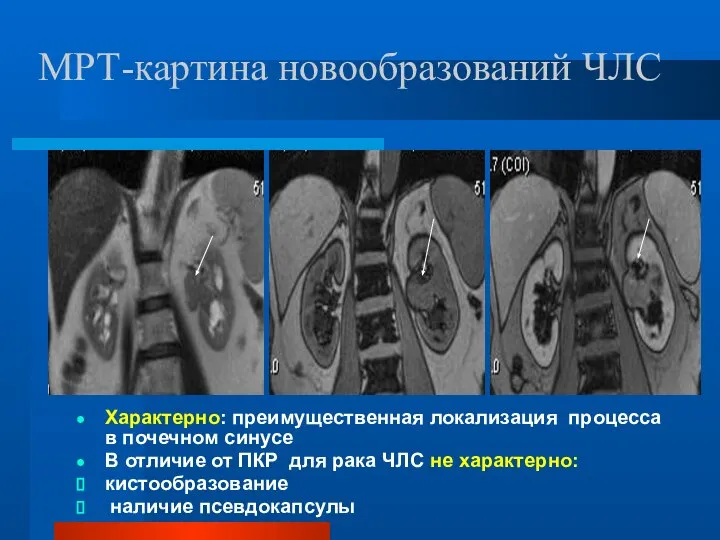 МРТ-картина новообразований ЧЛС Характерно: преимущественная локализация процесса в почечном синусе В отличие