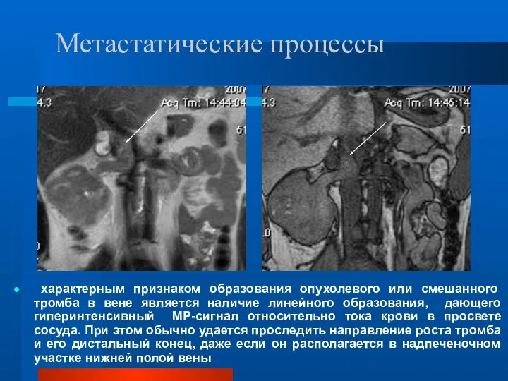 Метастатические процессы характерным признаком образования опухолевого или смешанного тромба в вене является