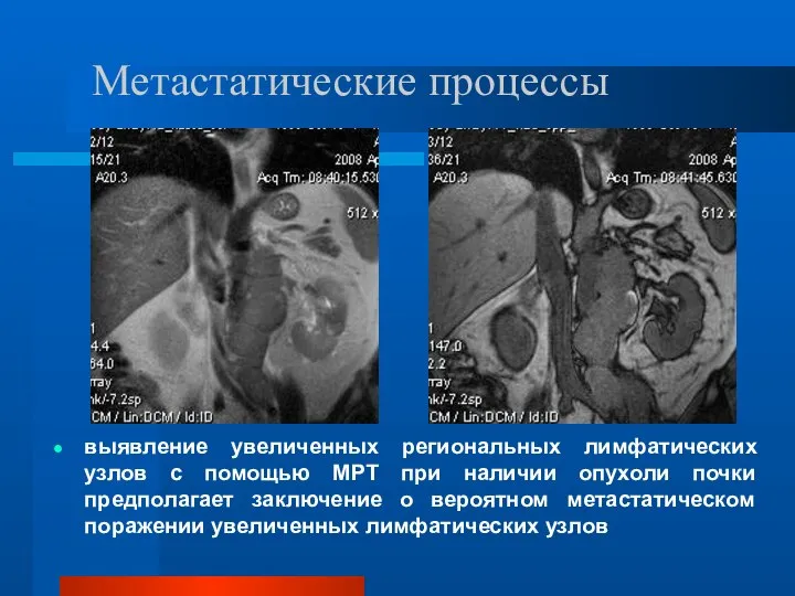 Метастатические процессы выявление увеличенных региональных лимфатических узлов с помощью МРТ при наличии