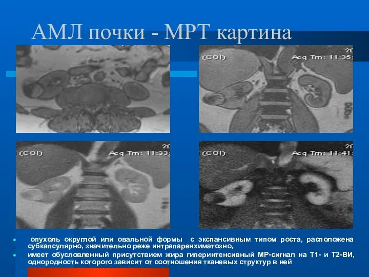 АМЛ почки - МРТ картина опухоль округлой или овальной формы с экспансивным