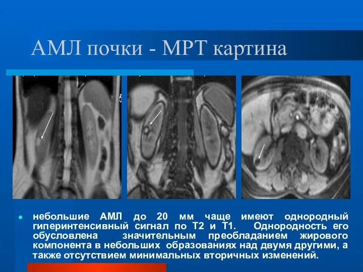АМЛ почки - МРТ картина небольшие АМЛ до 20 мм чаще имеют