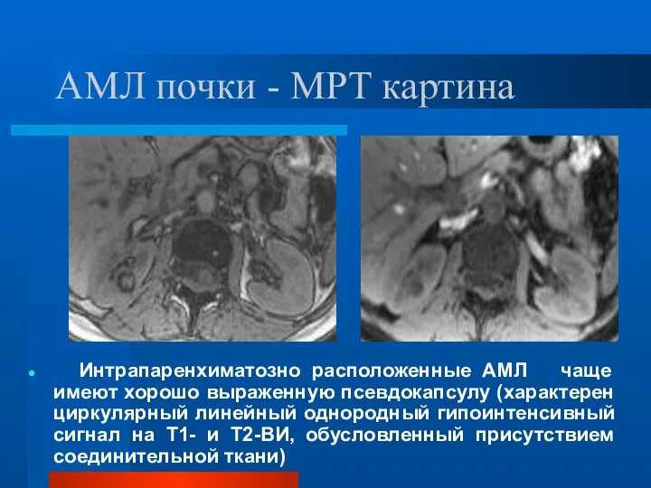 АМЛ почки - МРТ картина Интрапаренхиматозно расположенные АМЛ чаще имеют хорошо выраженную