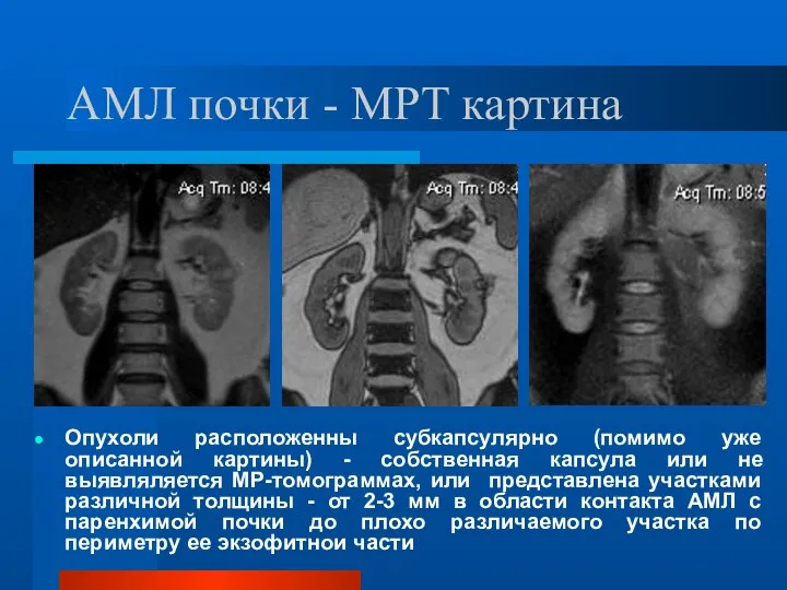 АМЛ почки - МРТ картина Опухоли расположенны субкапсулярно (помимо уже описанной картины)