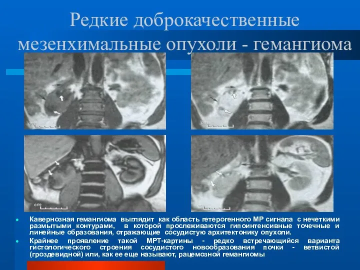 Редкие доброкачественные мезенхимальные опухоли - гемангиома Кавернозная гемангиома выглядит как область гетерогенного