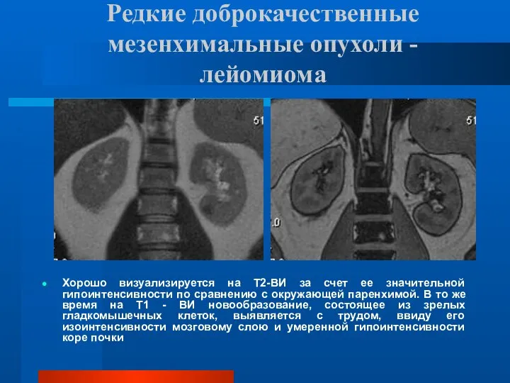 Редкие доброкачественные мезенхимальные опухоли - лейомиома Хорошо визуализируется на Т2-ВИ за счет