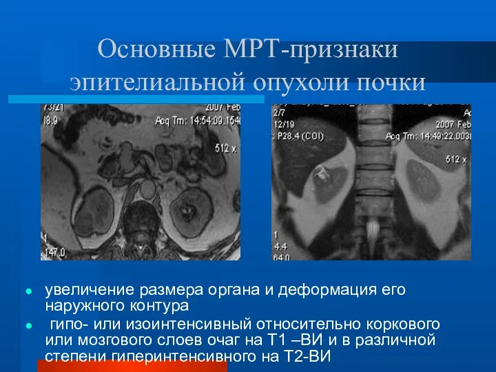Основные МРТ-признаки эпителиальной опухоли почки увеличение размера органа и деформация его наружного