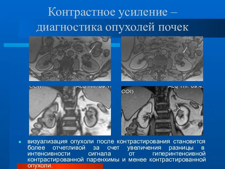 Контрастное усиление – диагностика опухолей почек визуализация опухоли после контрастирования становится более