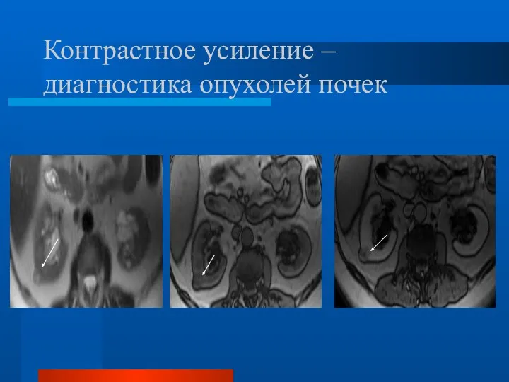 Контрастное усиление – диагностика опухолей почек