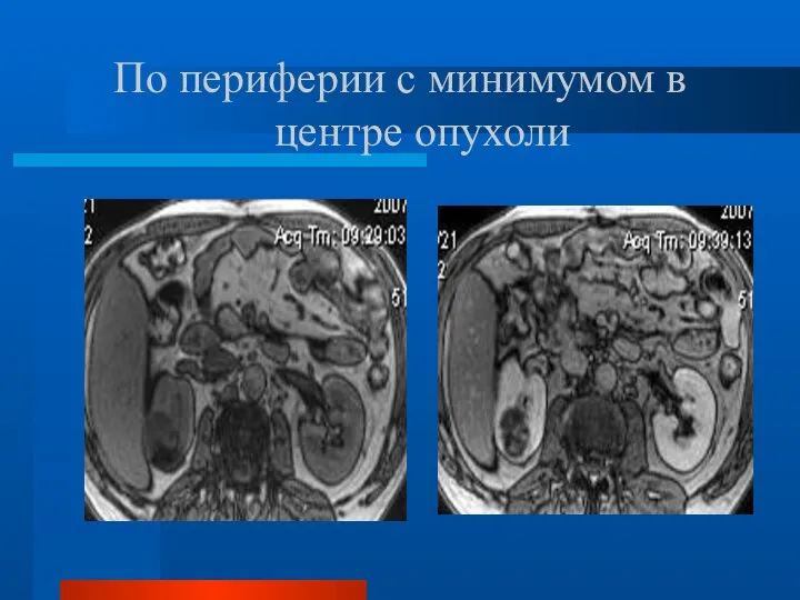 По периферии с минимумом в центре опухоли