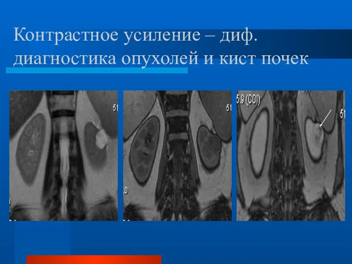 Контрастное усиление – диф. диагностика опухолей и кист почек