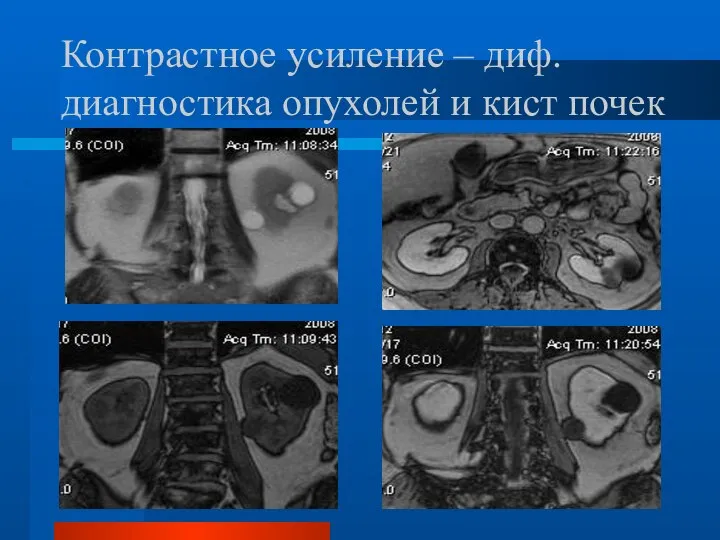 Контрастное усиление – диф. диагностика опухолей и кист почек