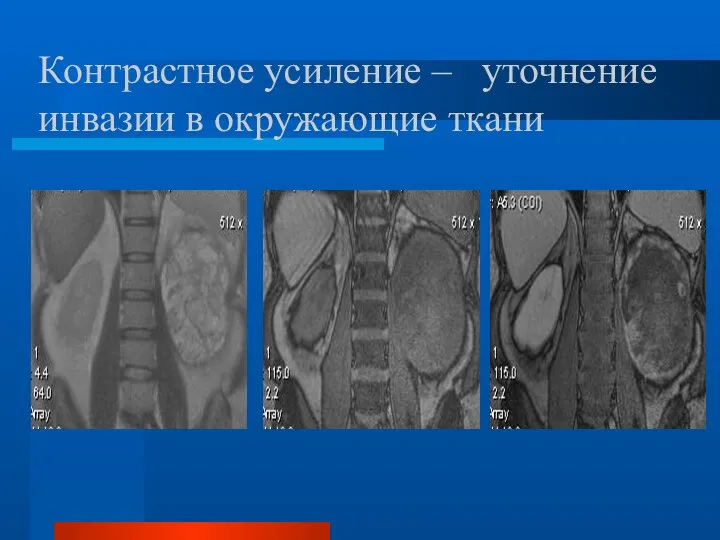 Контрастное усиление – уточнение инвазии в окружающие ткани