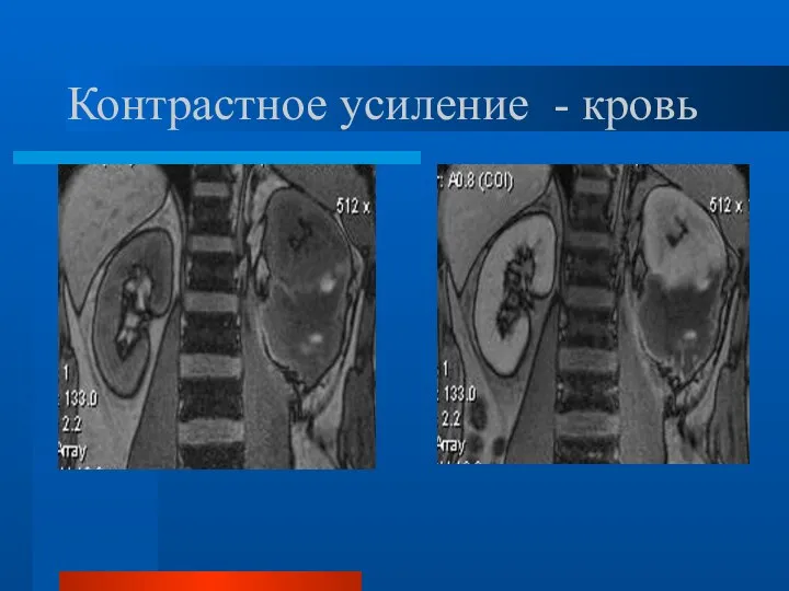 Контрастное усиление - кровь