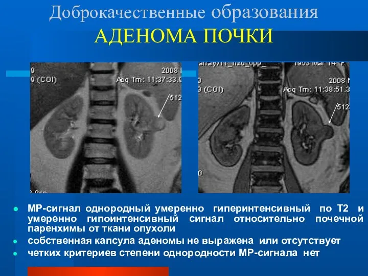 Доброкачественные образования АДЕНОМА ПОЧКИ МР-сигнал однородный умеренно гиперинтенсивный по Т2 и умеренно