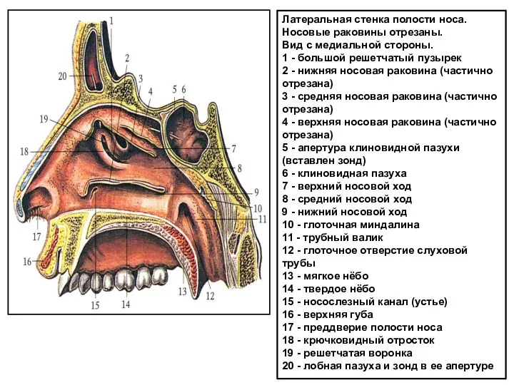 Латеральная стенка полости носа. Носовые раковины отрезаны. Вид с медиальной стороны. 1