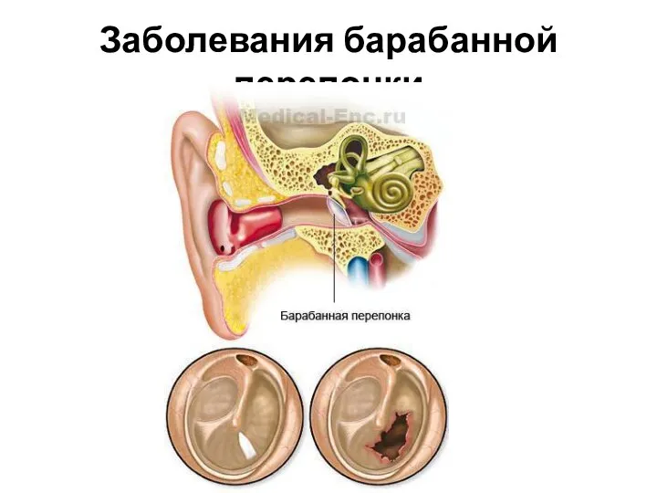 Заболевания барабанной перепонки