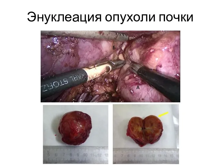 Энуклеация опухоли почки