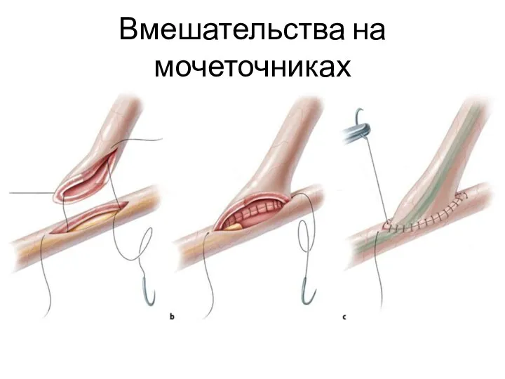 Вмешательства на мочеточниках