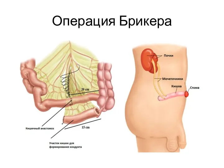 Операция Брикера